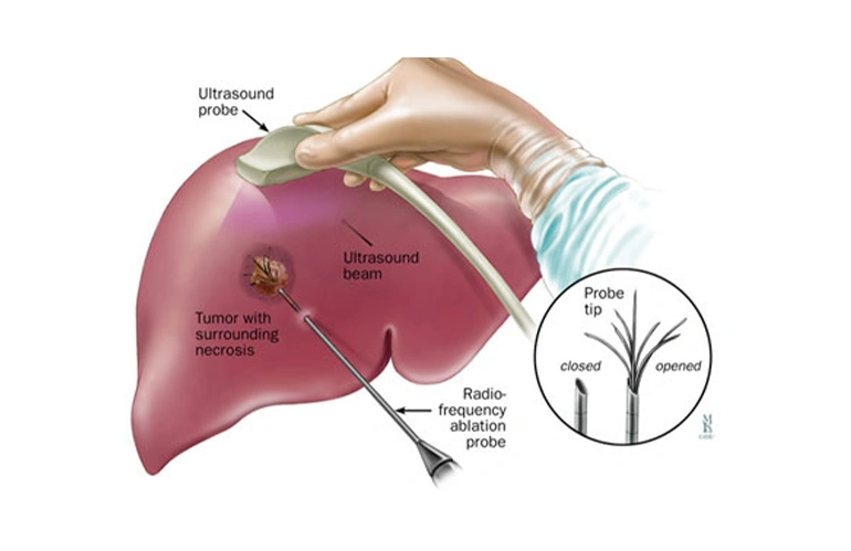 Liver Transplant interventions 02m